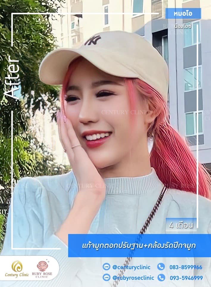 รีวิว แก้จมูก #511 , Century Clinic Thailand Century-รีวิว-แก้จมูก 1#511