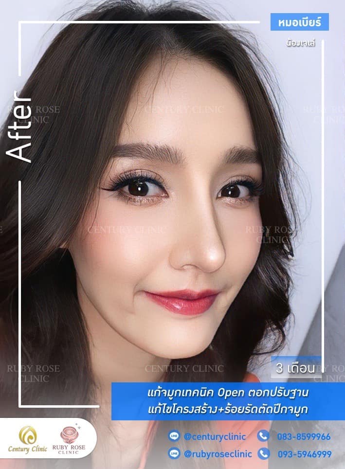 รีวิว แก้จมูก #512 , Century Clinic Thailand Century-รีวิว-แก้จมูก 1#512