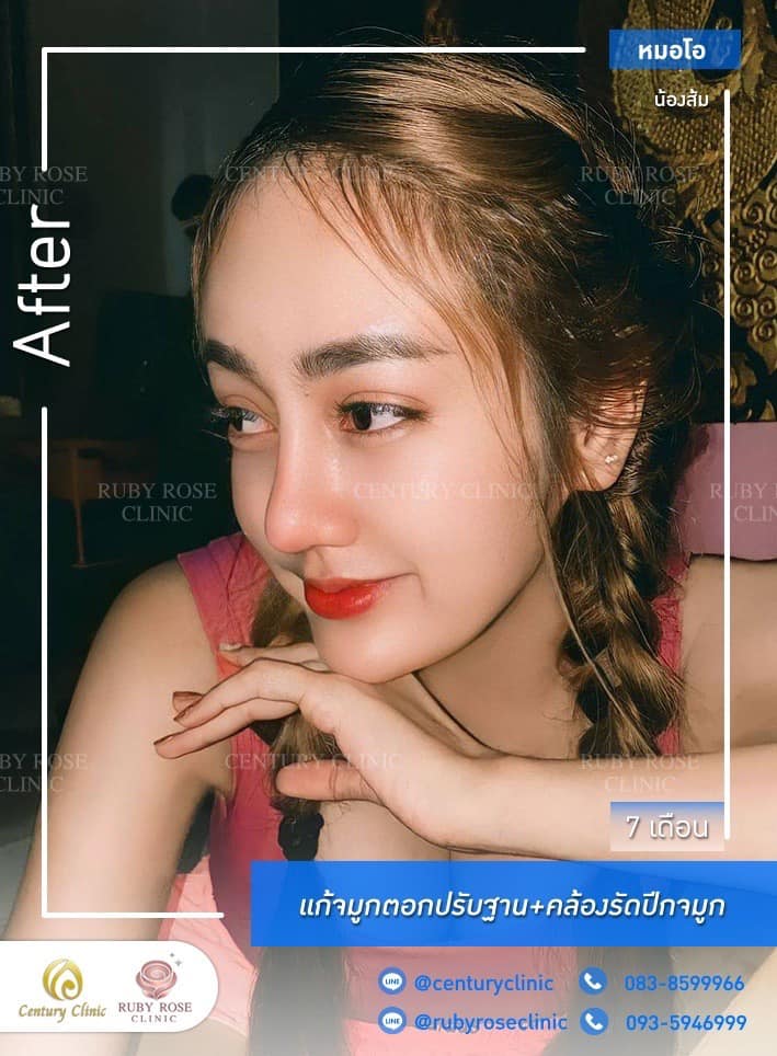 รีวิว แก้จมูก #516 , Century Clinic Thailand Century-รีวิว-แก้จมูก 1#516