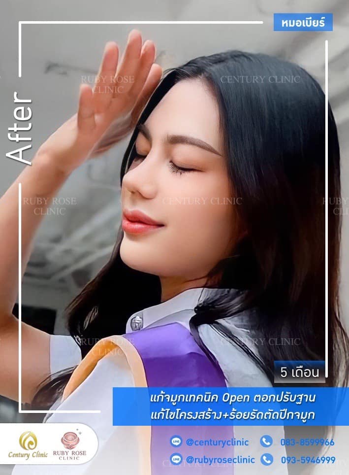 รีวิว แก้จมูก #517 , Century Clinic Thailand Century-รีวิว-แก้จมูก 1#517