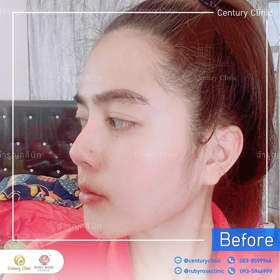 Century-รีวิว-แก้จมูก 1#521