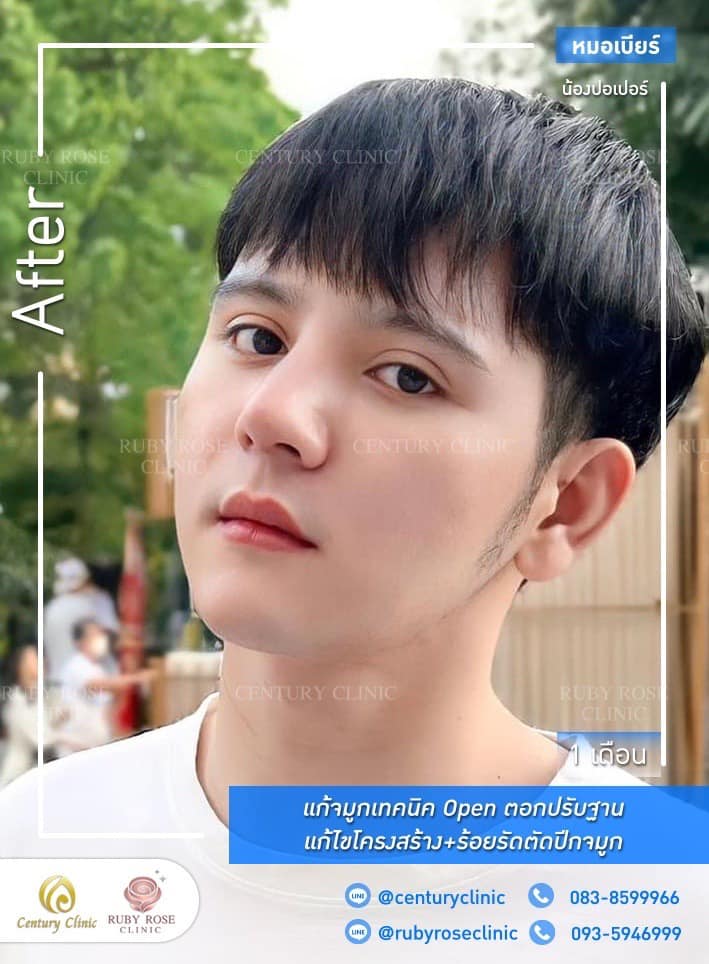 Century-รีวิว-แก้จมูก 1#522