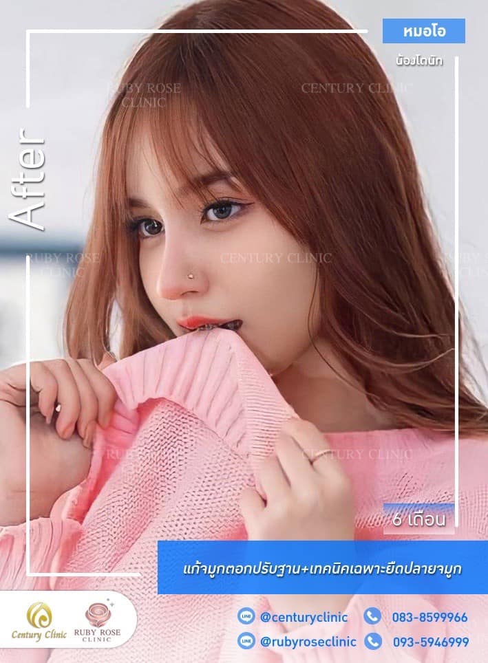 Century-รีวิว-แก้จมูก 1#526