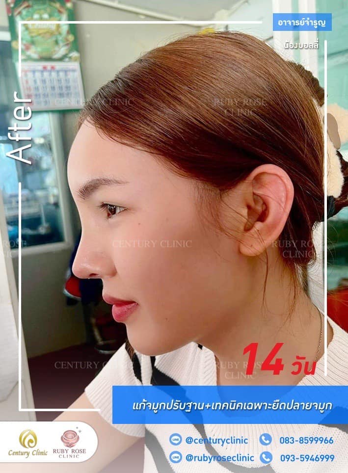 Century-รีวิว-แก้จมูก 1#528
