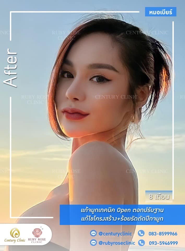 Century-รีวิว-แก้จมูก 2#532