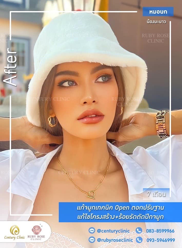 Century-รีวิว-แก้จมูก 1#535