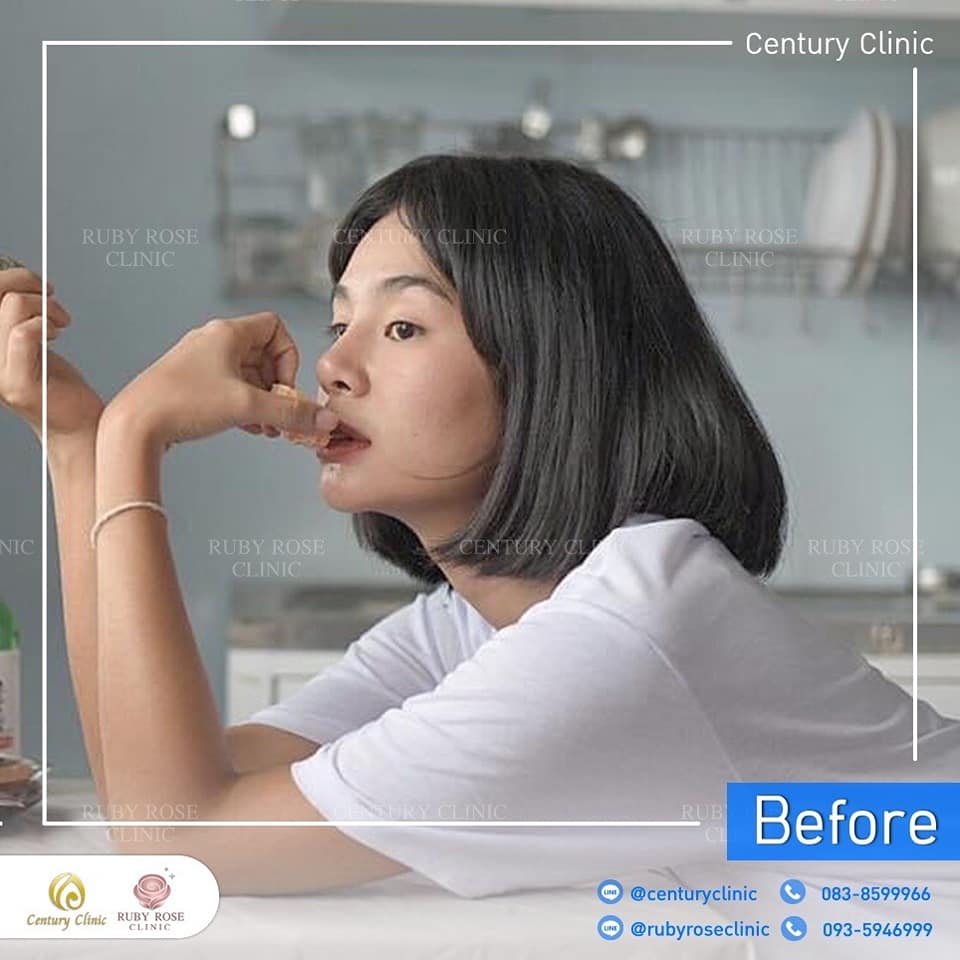 รีวิว แก้จมูก #536 , Century Clinic Thailand Century-รีวิว-แก้จมูก 1#536