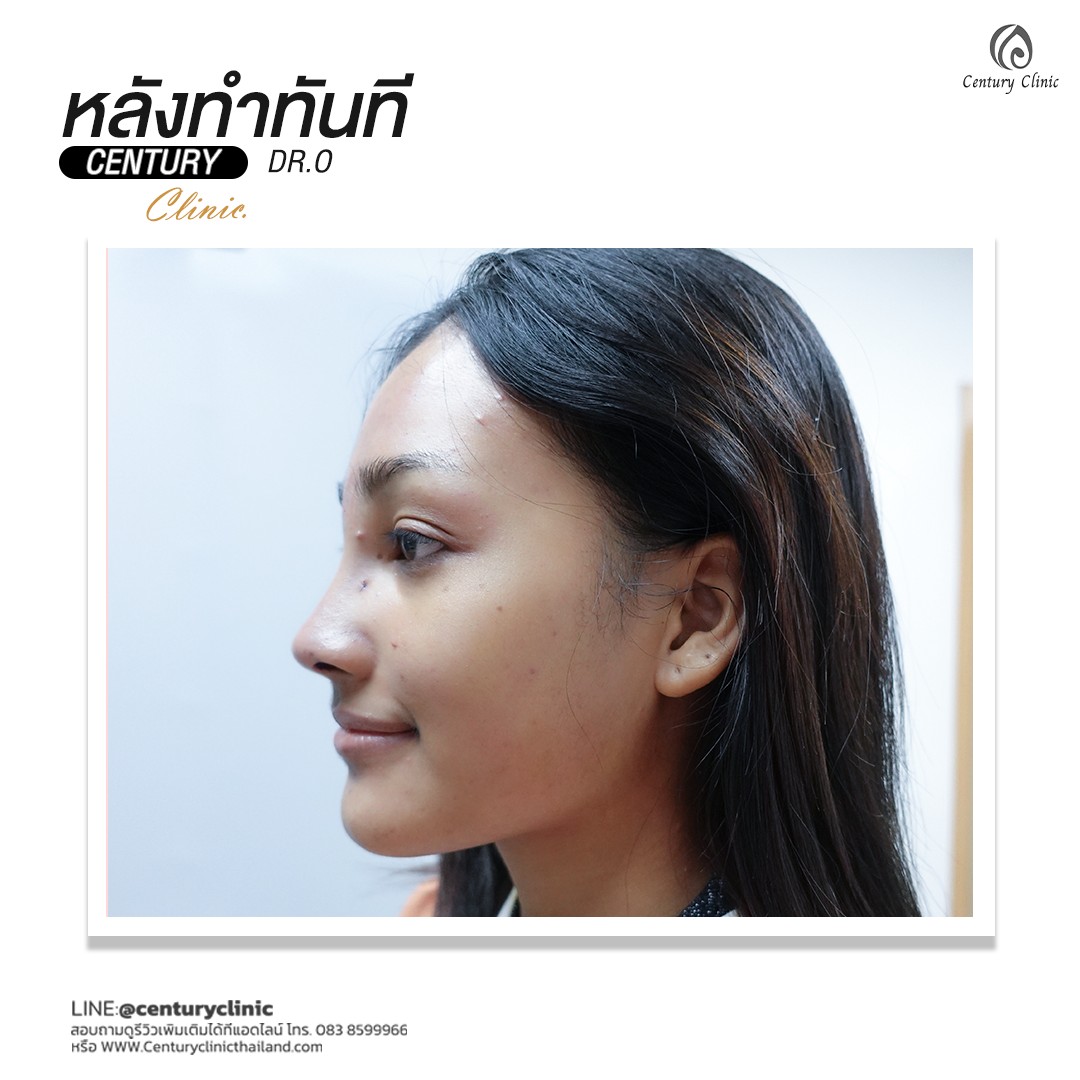 รีวิว แก้จมูก #548 , Century Clinic Thailand Century-รีวิว-แก้จมูก 1#548