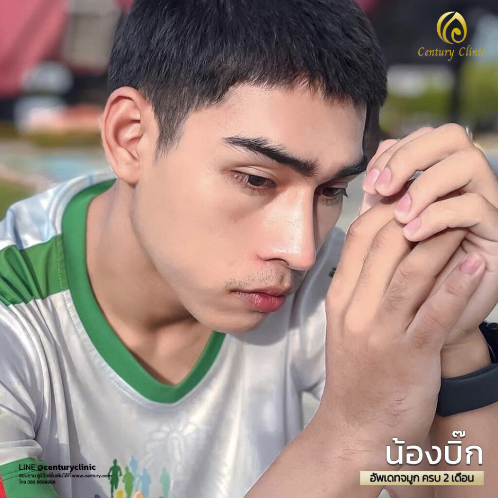 Century-รีวิว-แก้จมูก 1#552