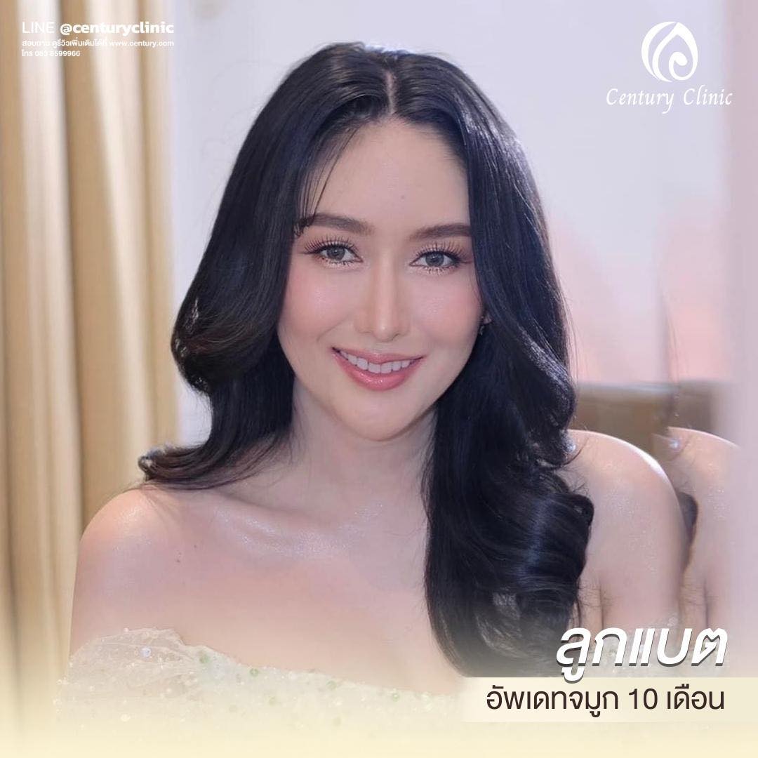 รีวิว แก้จมูก #572 , Century Clinic Thailand Century-รีวิว-แก้จมูก 1#572