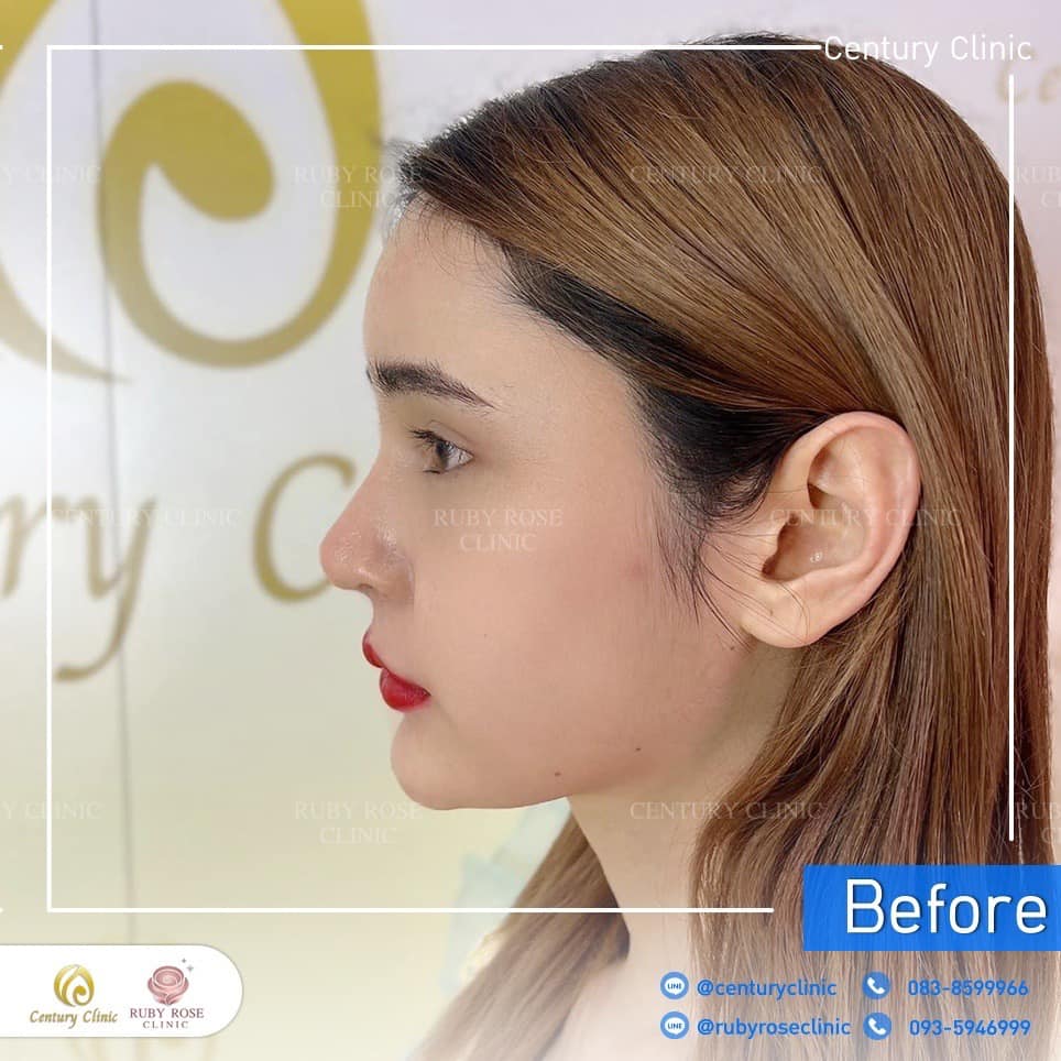 Century-รีวิว-แก้จมูก 2#510