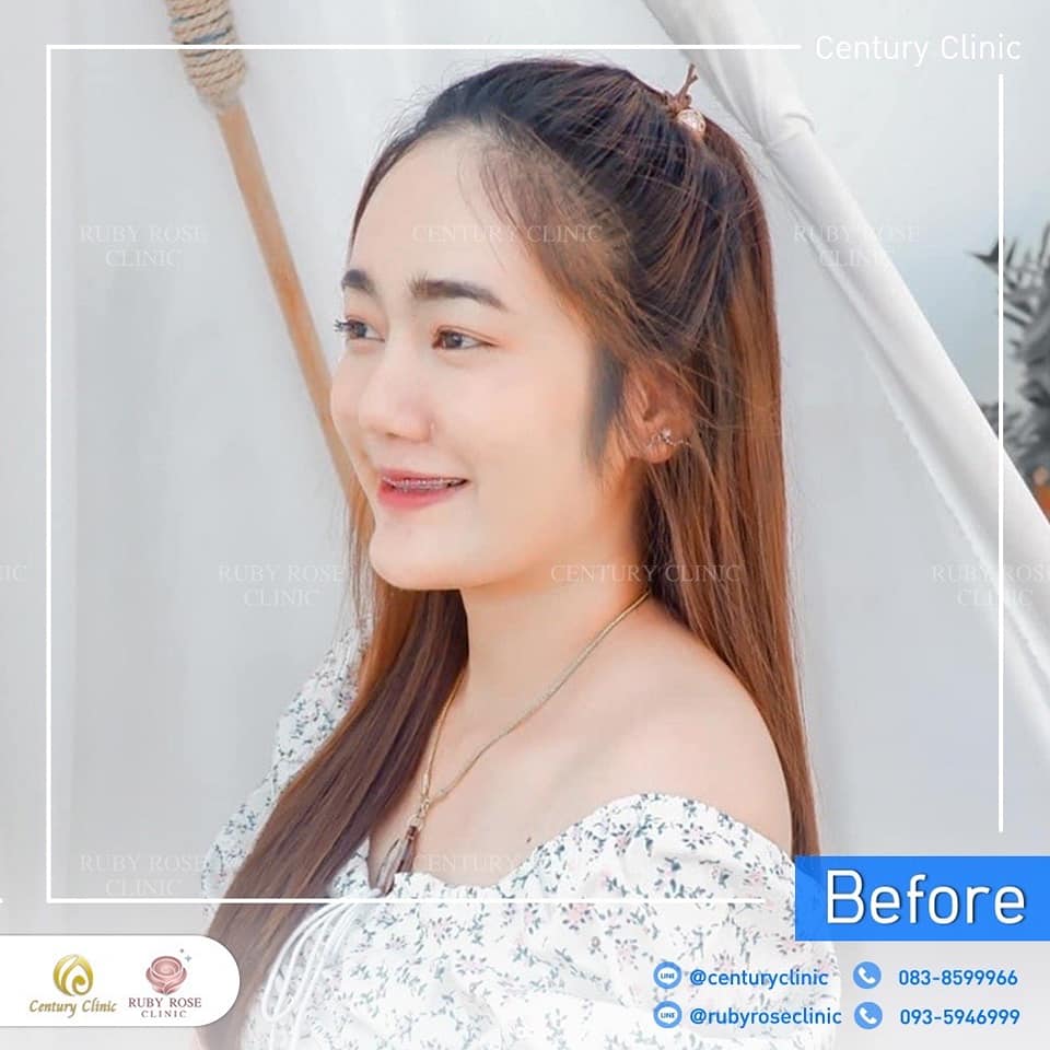 รีวิว แก้จมูก #516 , Century Clinic Thailand Century-รีวิว-แก้จมูก 2#516