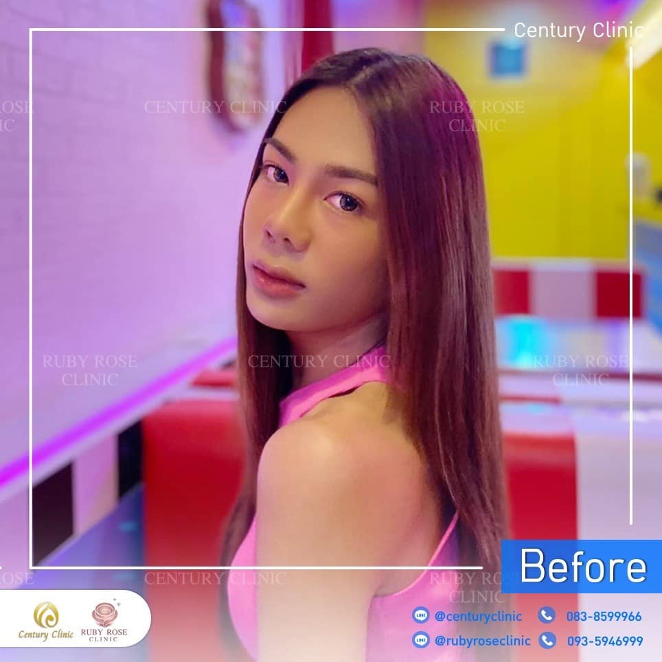 รีวิว แก้จมูก #517 , Century Clinic Thailand Century-รีวิว-แก้จมูก 2#517