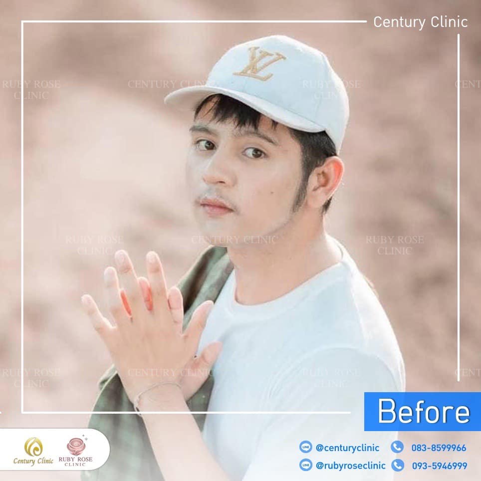 Century-รีวิว-แก้จมูก 2#522