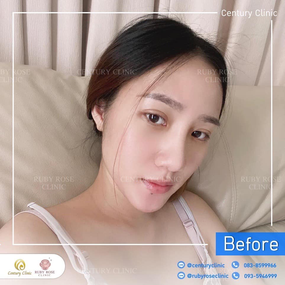 รีวิว แก้จมูก #523 , Century Clinic Thailand Century-รีวิว-แก้จมูก 2#523