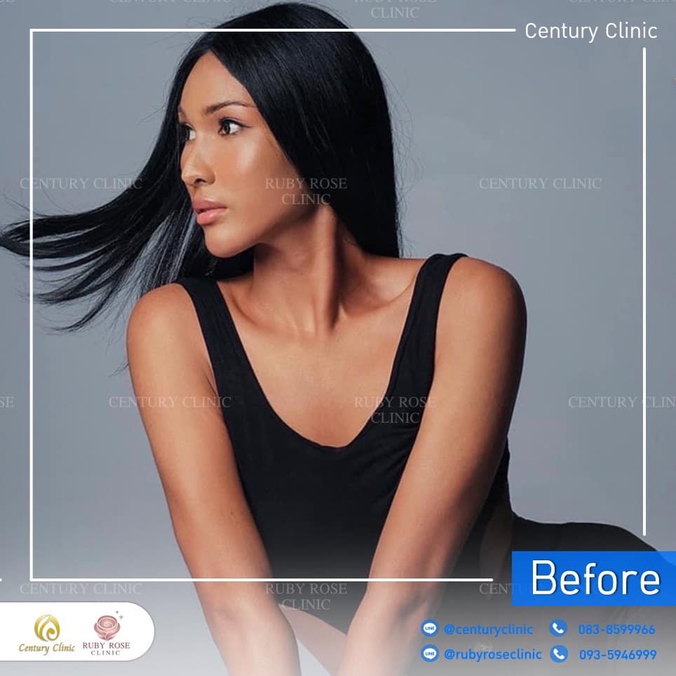 Century-รีวิว-แก้จมูก 2#531