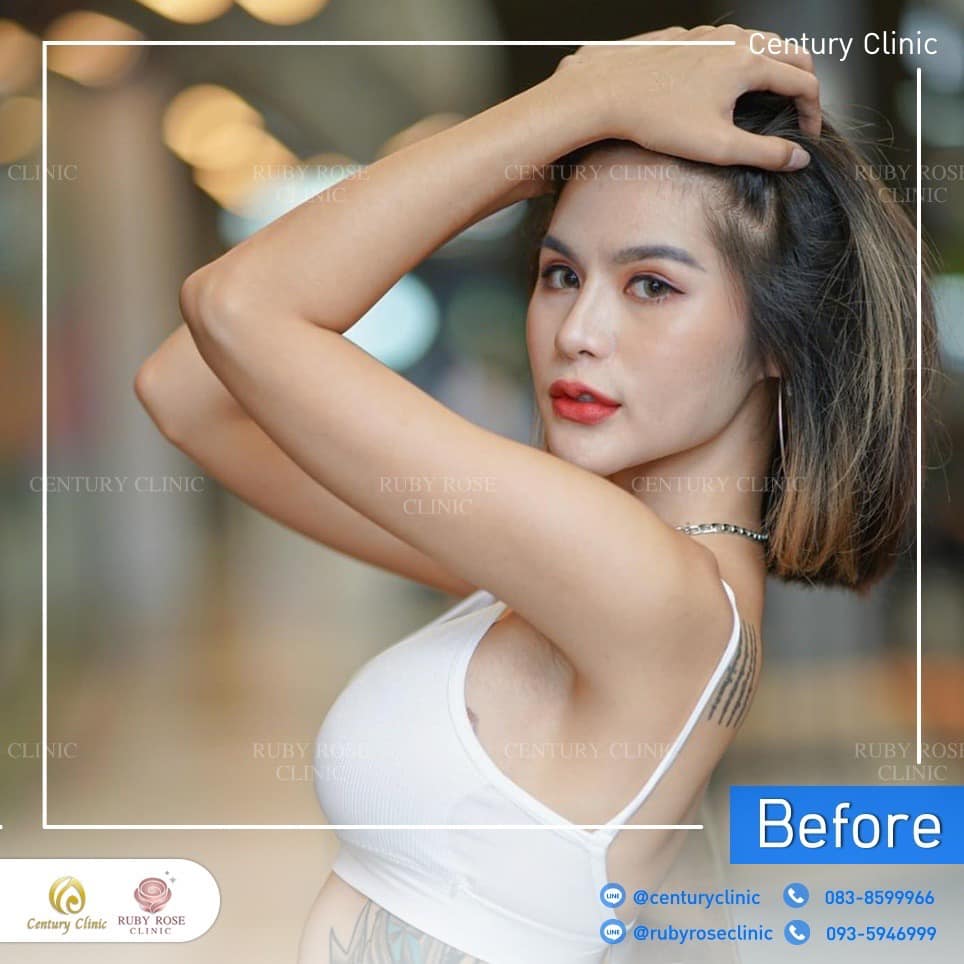 Century-รีวิว-แก้จมูก 2#532