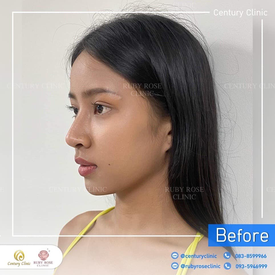 Century-รีวิว-แก้จมูก 2#533