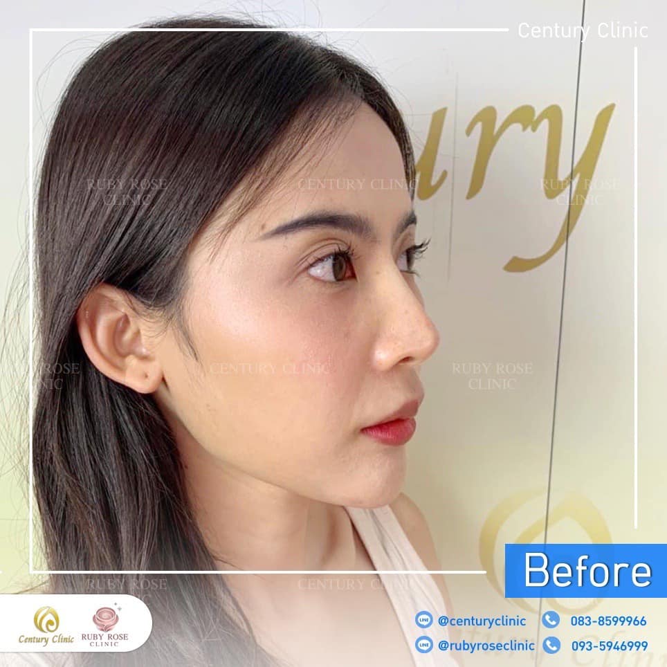 Century-รีวิว-แก้จมูก 2#534