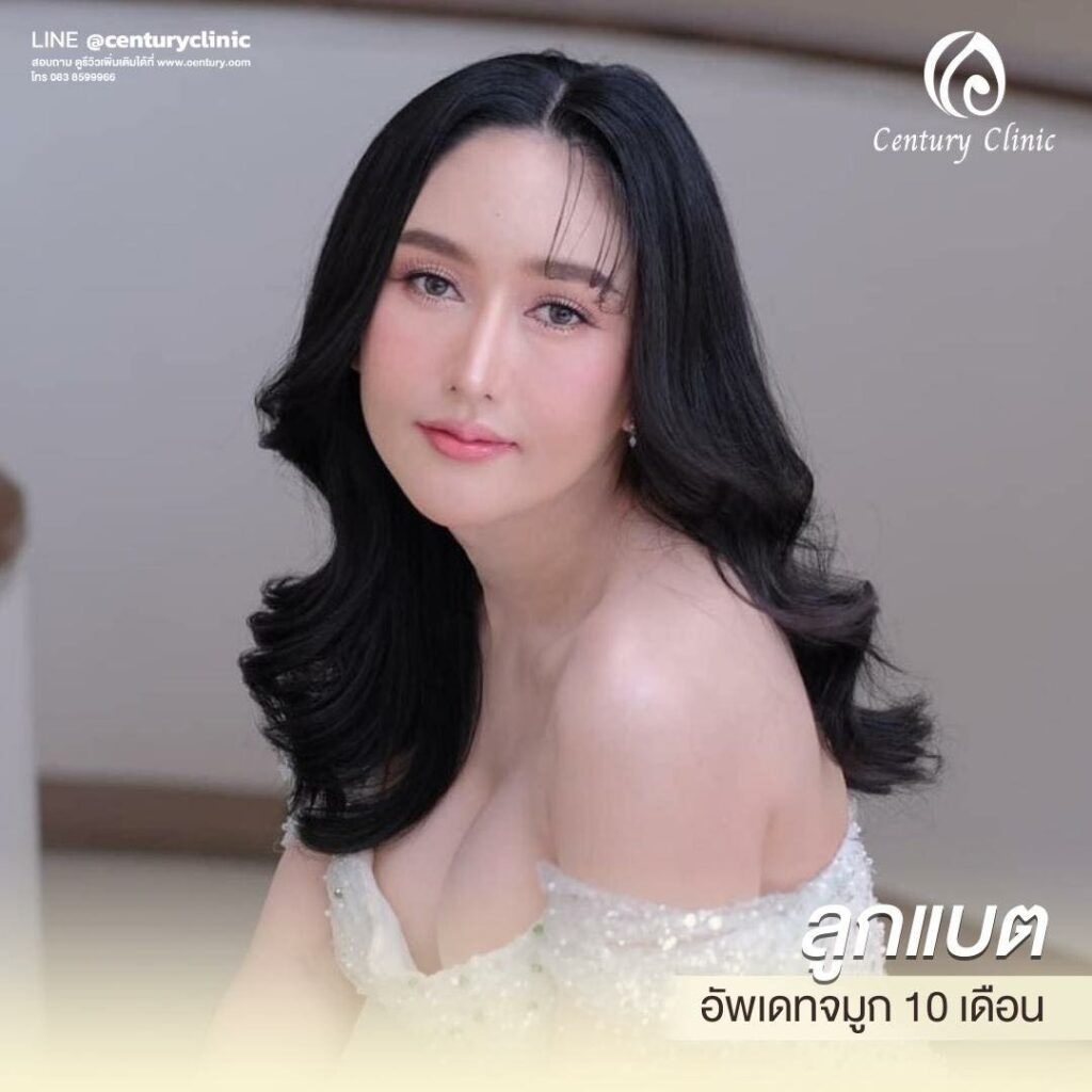 รีวิว แก้จมูก #572 , Century Clinic Thailand Century-รีวิว-แก้จมูก 1#572