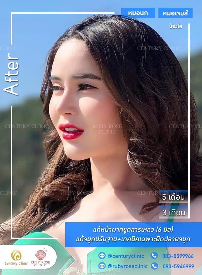Century-รีวิว-แก้จมูก #510