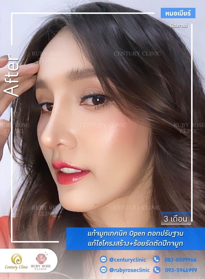 รีวิว แก้จมูก #512 , Century Clinic Thailand Century-รีวิว-แก้จมูก #512