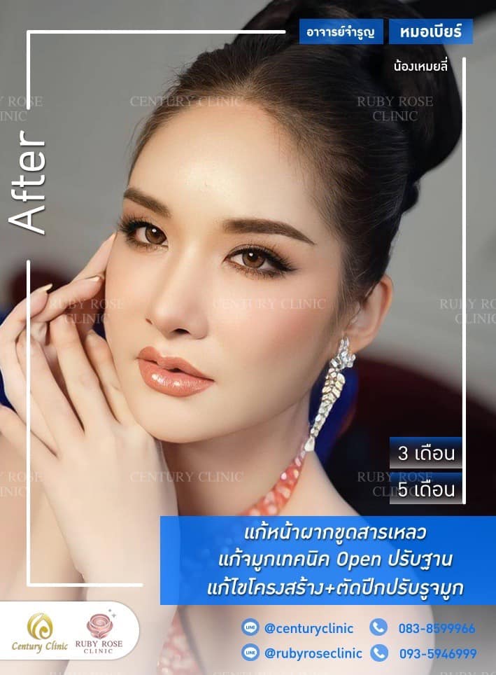 Century-รีวิว-แก้จมูก #513