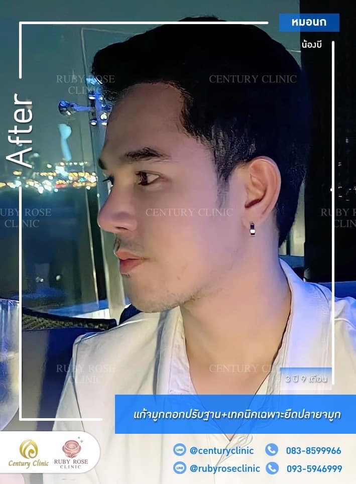 Century-รีวิว-แก้จมูก #515