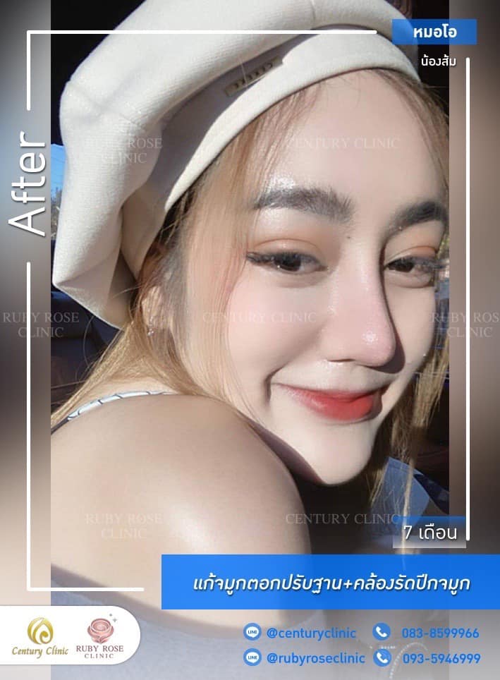 รีวิว แก้จมูก #516 , Century Clinic Thailand Century-รีวิว-แก้จมูก #516