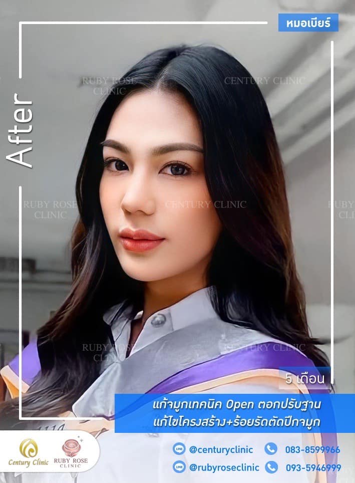 รีวิว แก้จมูก #517 , Century Clinic Thailand Century-รีวิว-แก้จมูก #517