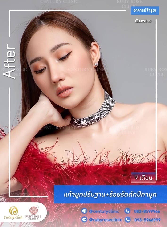 รีวิว แก้จมูก #523 , Century Clinic Thailand Century-รีวิว-แก้จมูก #523