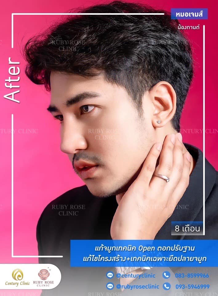 Century-รีวิว-แก้จมูก #524