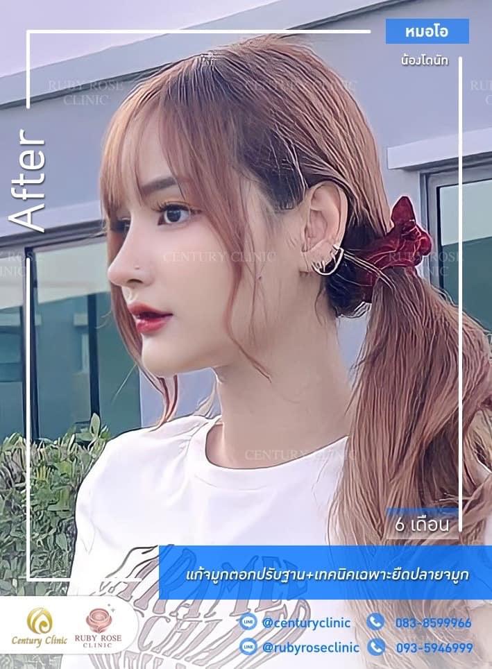 Century-รีวิว-แก้จมูก #526