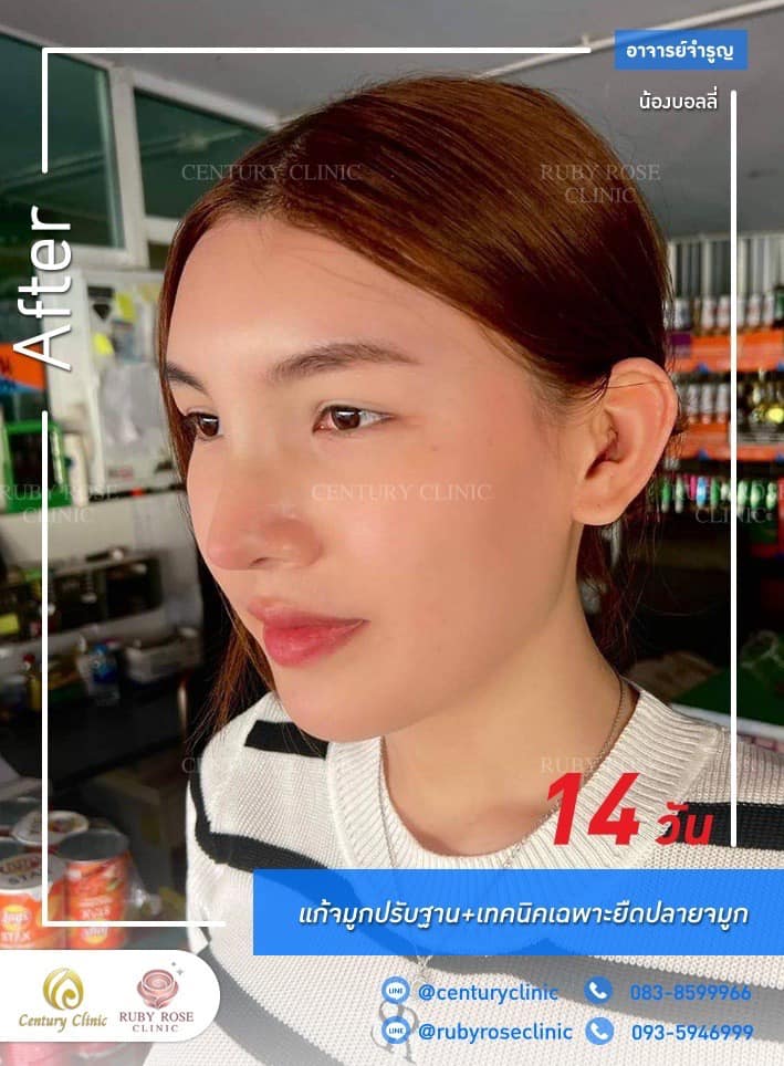 Century-รีวิว-แก้จมูก #528