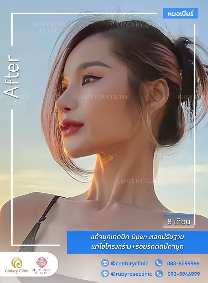 Century-รีวิว-แก้จมูก #532
