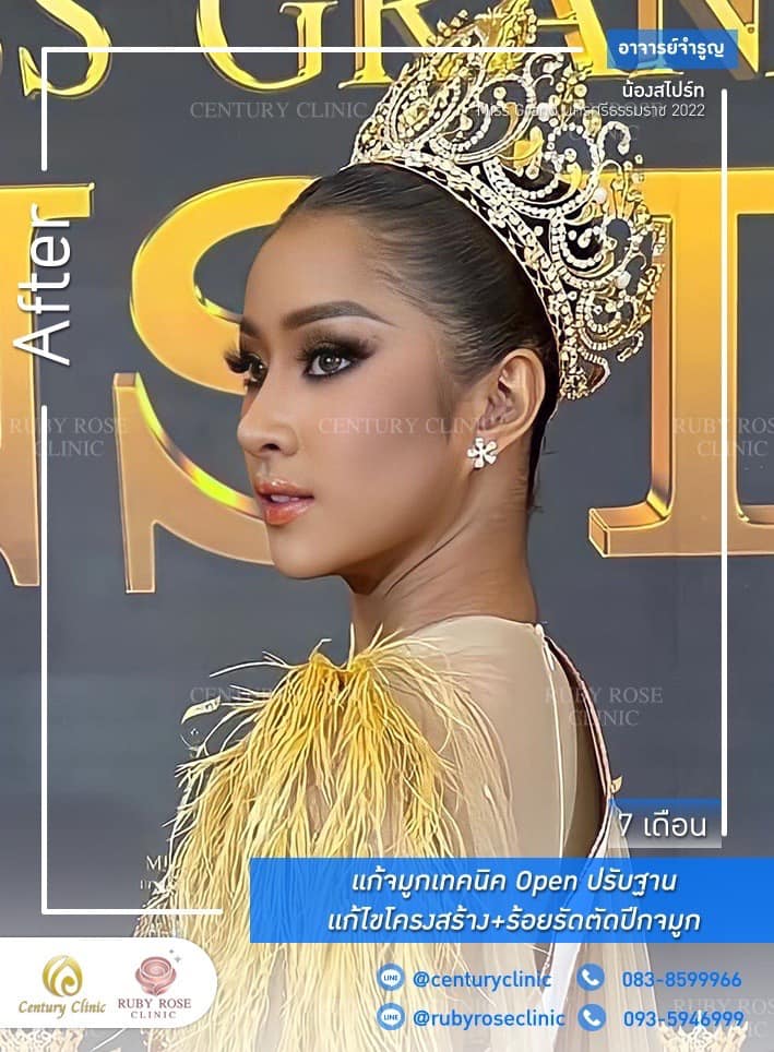 Century-รีวิว-แก้จมูก #533