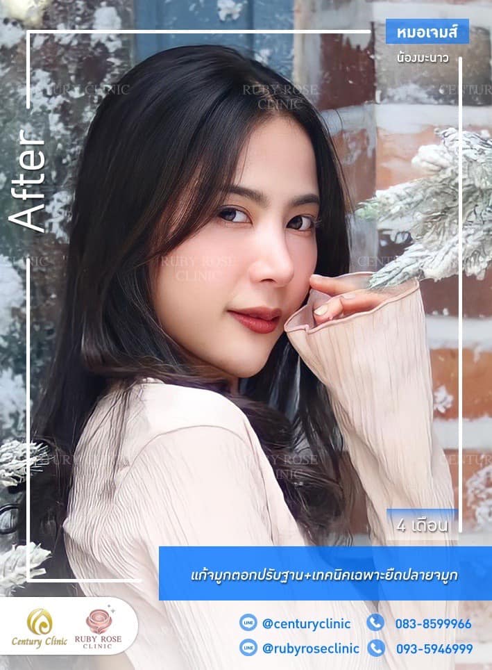 Century-รีวิว-แก้จมูก #534