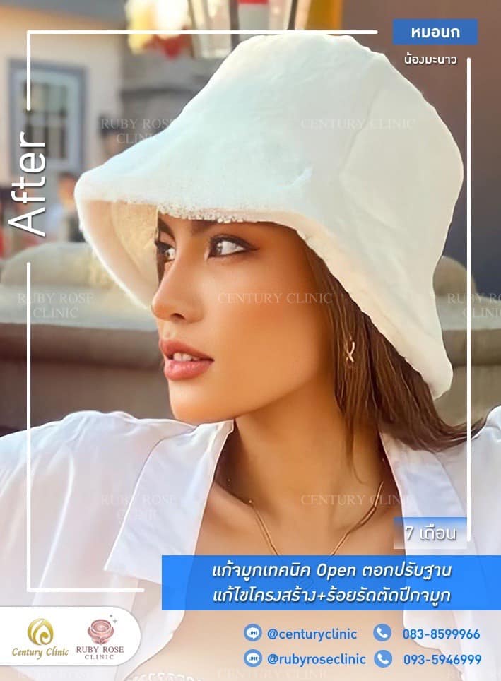Century-รีวิว-แก้จมูก #535