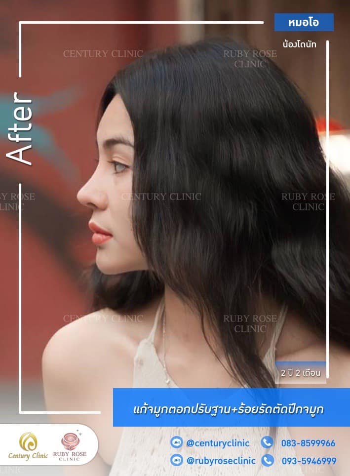 Century-รีวิว-แก้จมูก #536