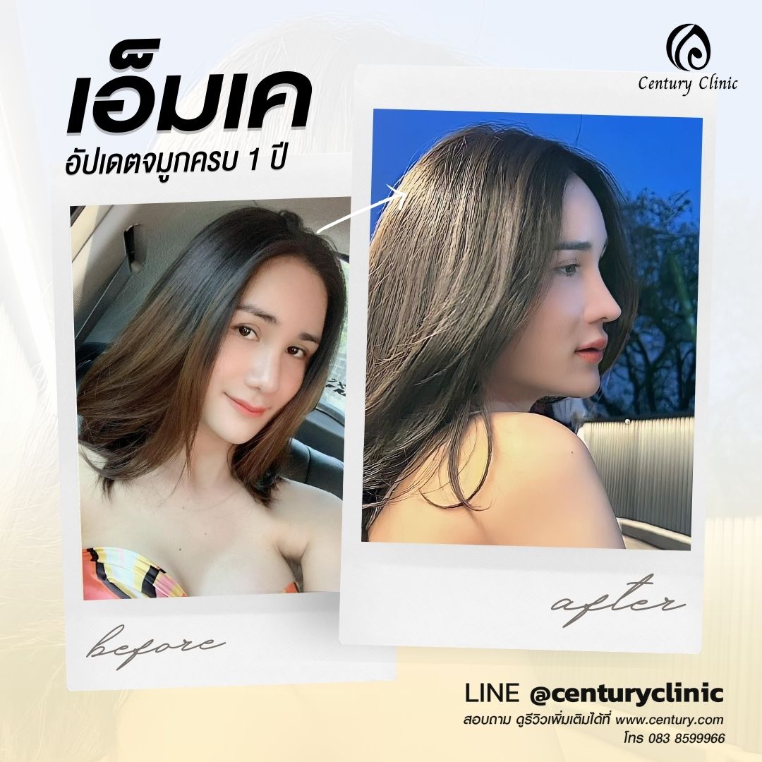 รีวิว แก้จมูก #542 , Century Clinic Thailand Century-รีวิว-แก้จมูก #542