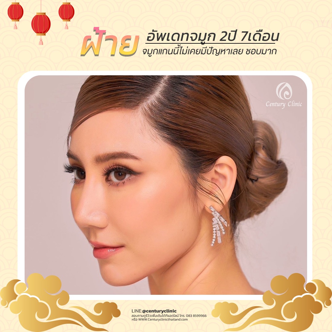 รีวิว แก้จมูก #546 , Century Clinic Thailand Century-รีวิว-แก้จมูก #546
