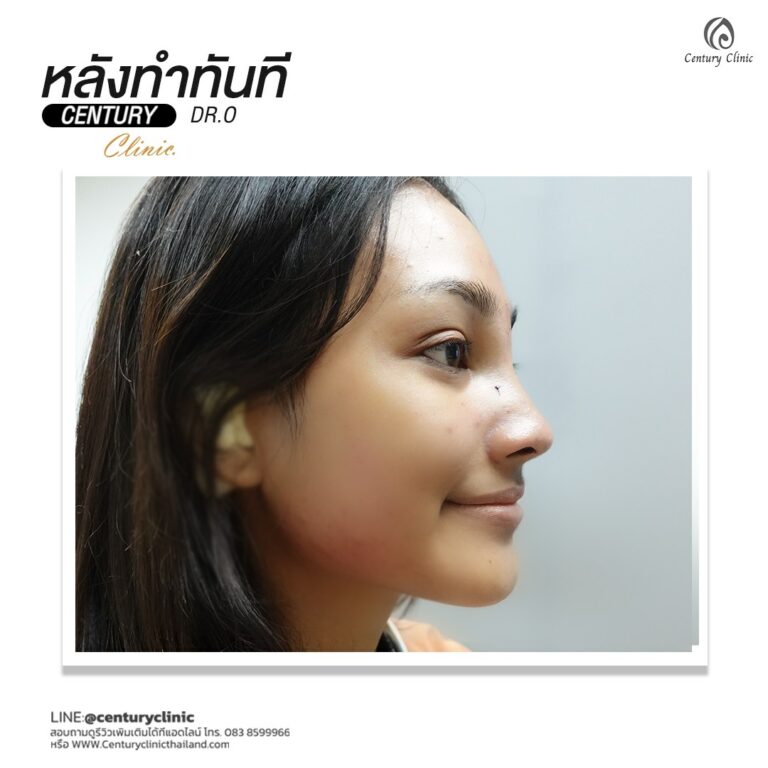 Century-รีวิว-แก้จมูก #548