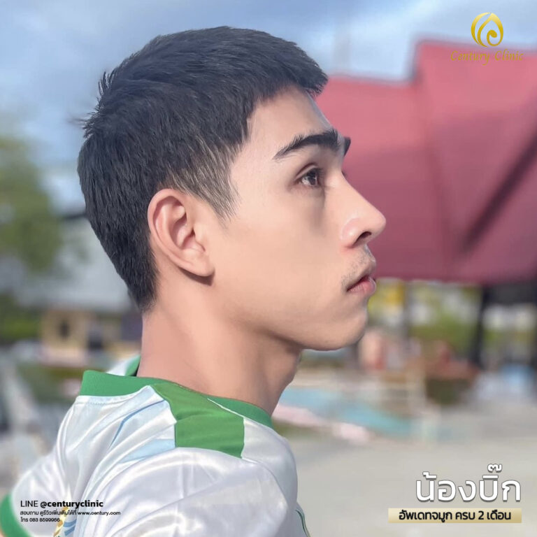 Century-รีวิว-แก้จมูก #552