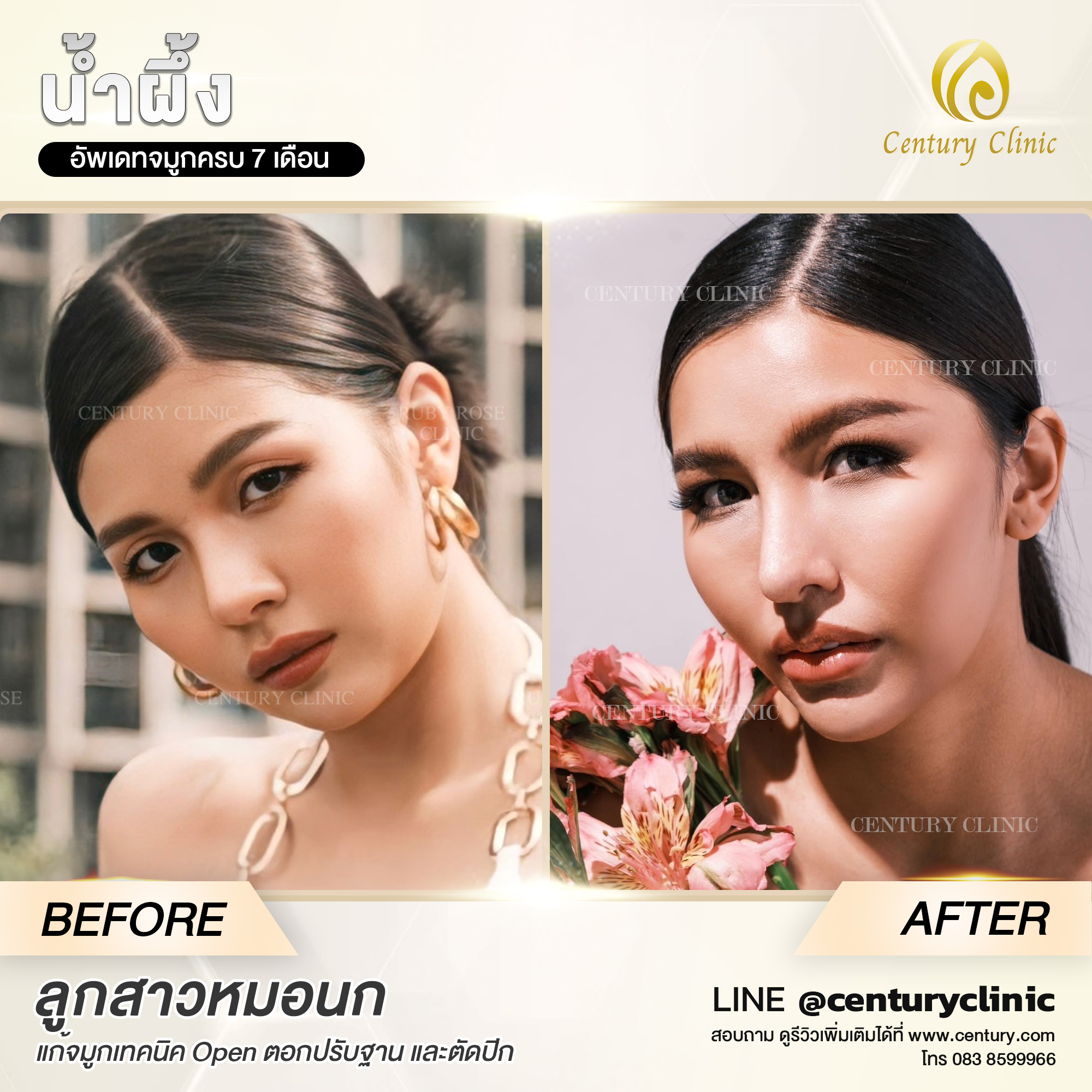 รีวิว แก้จมูก #566 , Century Clinic Thailand Century-รีวิว-แก้จมูก #566