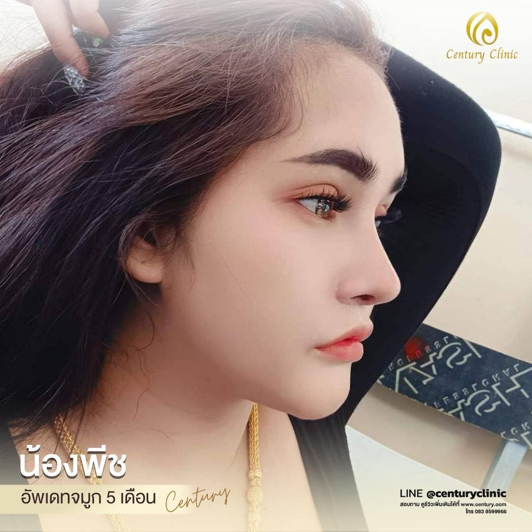 Century-รีวิว-แก้จมูก #570