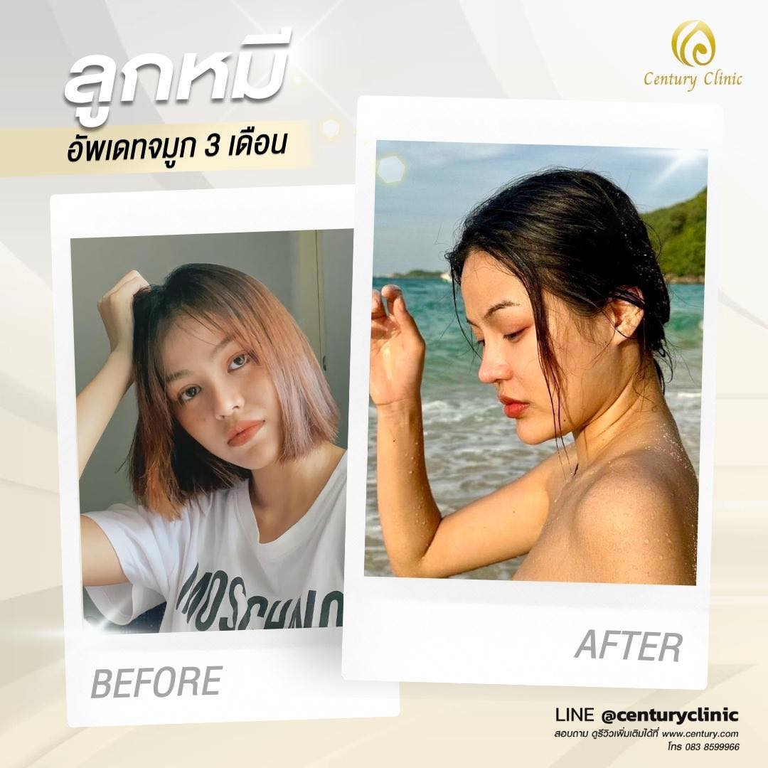 Century-รีวิว-แก้จมูก #574