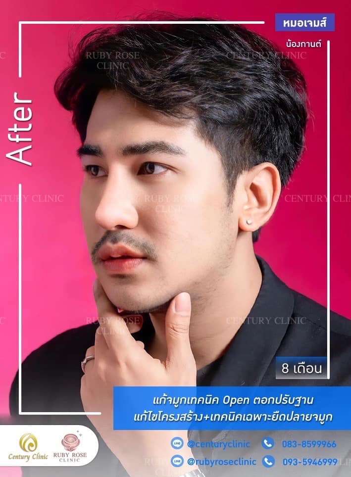 Century-รีวิว-แก้จมูก1#524