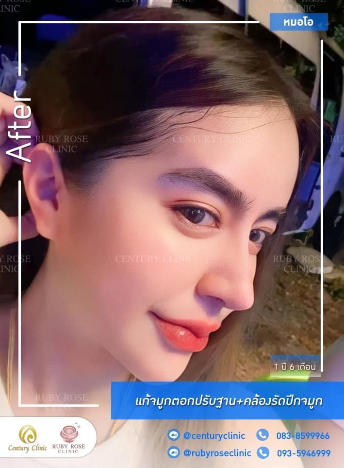 Century-รีวิว-แก้จมูก#521