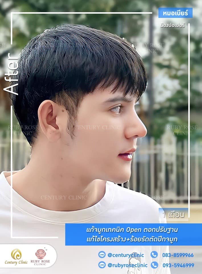Century-รีวิว-แก้จมูก#522