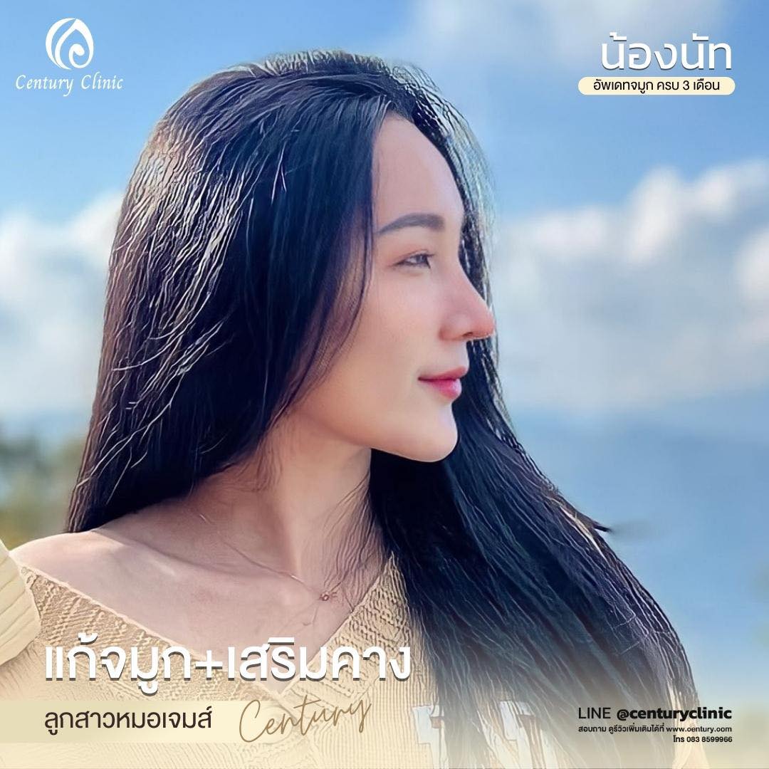 Century-รีวิว-แก้จมูก+เสริมคาง #563